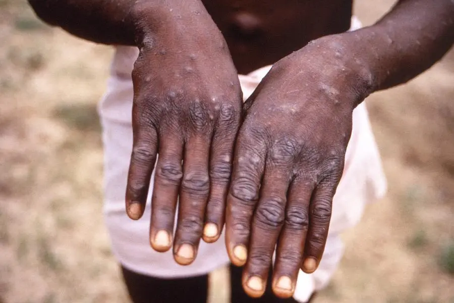 Kuwait Health Ministry following up on monkeypox outbreak in Africa – ZAWYA